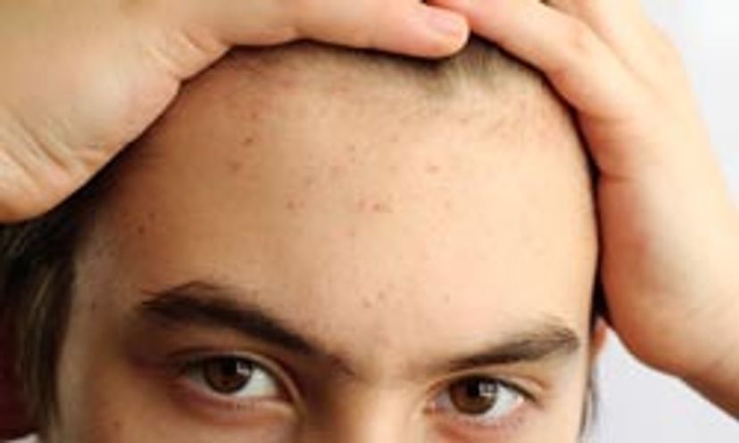 How much do you know about scalp pimples?