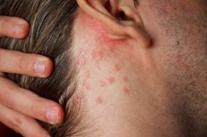 Psoriasis skin disorder on neck