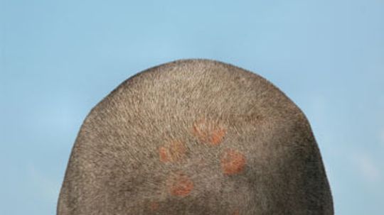 Scalp Sores