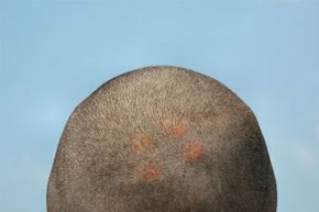 Those scalp sores could be the result of a number of skin conditions. See more pictures of skin problems.