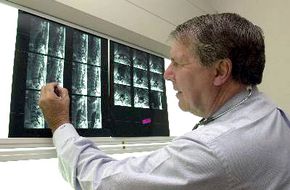 Dr. David Apple, Shepherd Center's medical director, checks an MRI (magnetic resonance image) to determine where a patient's spinal cord was injured.