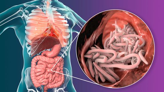 Ascaris Lumbricoides: The Stomach Worm Nobody Wants