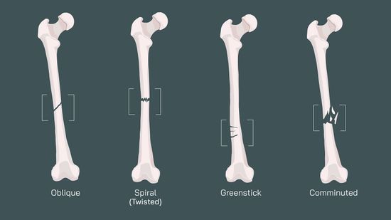 11 Types of fractures That Can Show Up in an X-ray or MRI