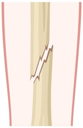 Displaced fracture