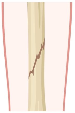 Oblique fracture