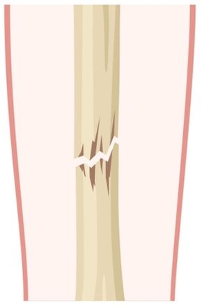 Closed fracture