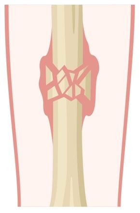 Comminuted fracture