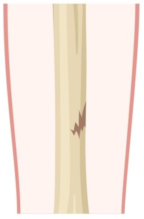 Greenstick fracture