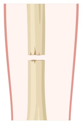 Transverse fracture