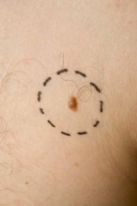 Melanoma, pictured here, is the number one cause of cancer deaths in women age 25 to 30.