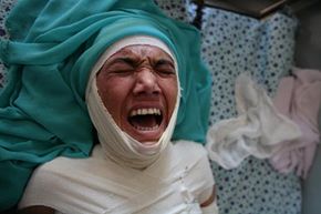  This woman has just finished a successful skin graft operation. Her anguish shows that skin grafts are a painful cure for an even more painful injury.