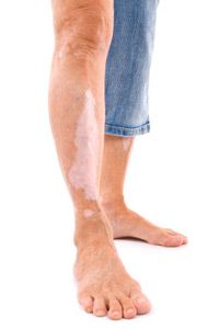 Leg with Vitiligo - skin disease.