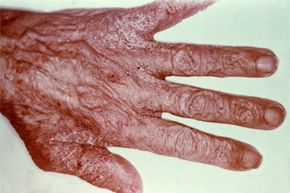 The scabies mite burrows under the skin, leaving an itchy, pimple-like rash.