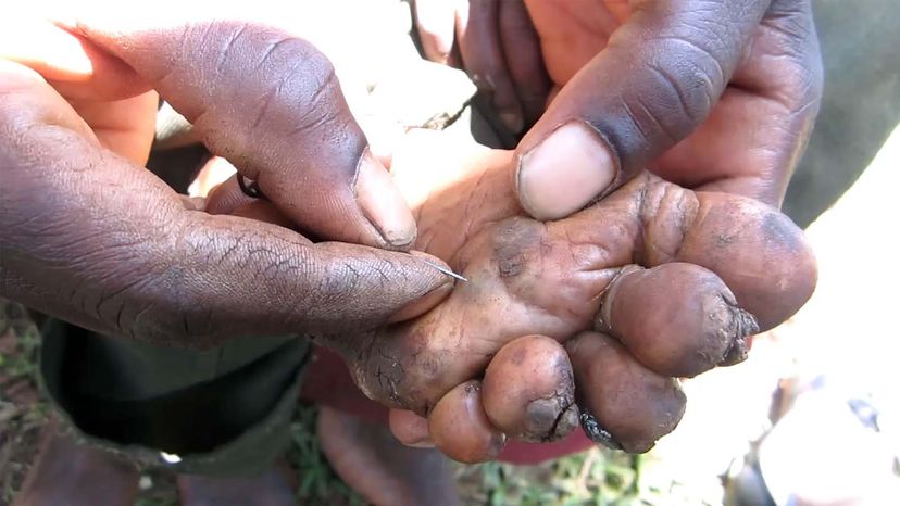 human parasite holes in skin