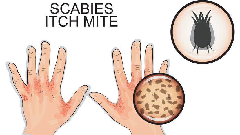 Scabies, Medicinal and Wild Maggots, and Medicinal and Wild