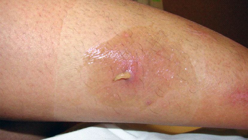 5 Parasites That Breed On and In Your Skin