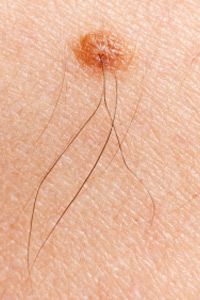 macro shot of melanoma with hairs on woman skin