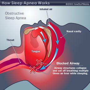 Sleep apnea