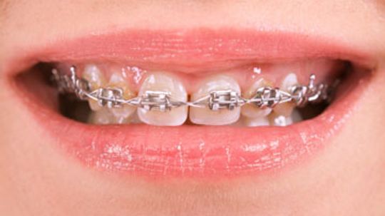 What are smart bracket braces?