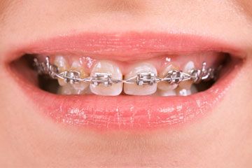 preteen boy wearing braces