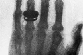 One of the first X-ray photographs, taken by German physicist Wilhelm Roentgen, showing his wife's hand and wedding ring.  It wasn't much later that people learned how dangerous prolonged exposure to X-rays could be.