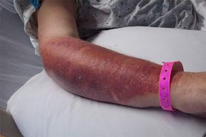 这个病人患有链球菌感染引起的蜂窝组织炎。＂border=