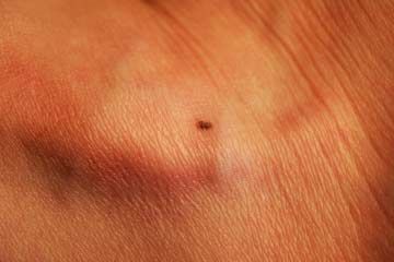 Close up of mole on skin.