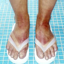 sunburned feet