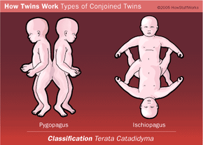 Terata Catadidyma refers to twins joined in the lower portion of their body, or they may appear to be two bodies on top and one body on the bottom.