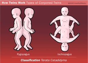 Terata Catadidyma是指双胞胎在其身体的下部连接在一起，或者它们似乎是顶部的两个身体，底部有一个身体。“border=