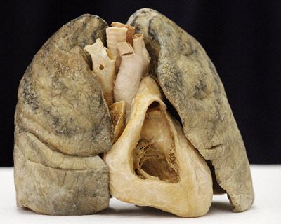 Smoker's heart and lungs