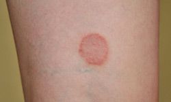 Ringworm isn't caused by a worm at all, but by a fungus.