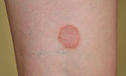 Tinea Corporis (Body Ringworm) - Dermatologic Disorders - Merck