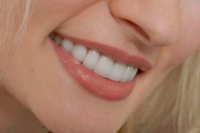 teeth veneers