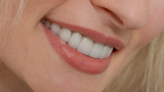 Teeth Veneers