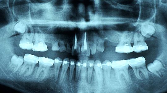 What Happens If Your Adult Teeth Just Don't Come In?