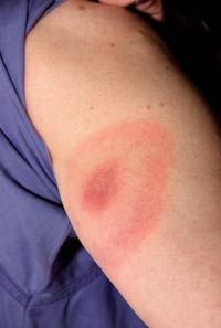 The bull’s-eye rash is a typical symptom of Lyme disease, which ticks can transmit to people and animals.