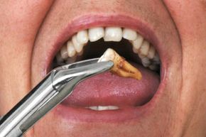 Cracked teeth are often extracted to prevent infection in the root canal.