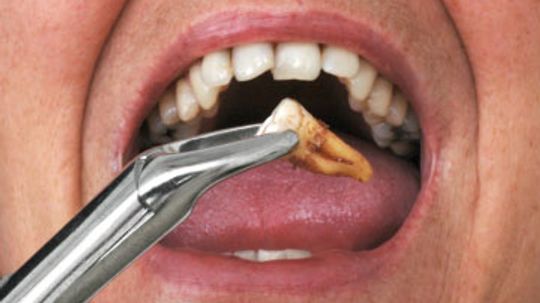 Tooth Extraction