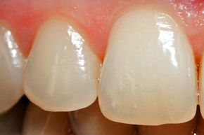 Tooth enamel is the hardest tissue our bodies produce. But if we don't take care of it, certain substances can wear it down and we can lose it forever.