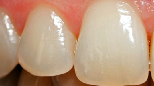 What wears down tooth enamel, and how can you prevent it?
