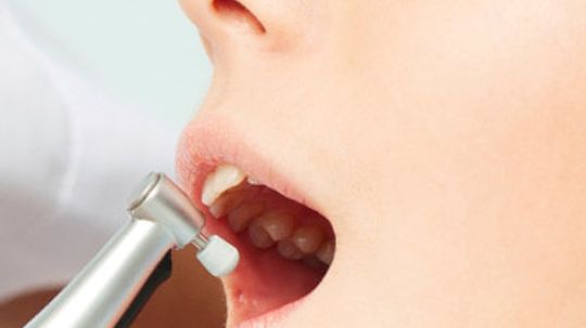Do DIY tooth polishers really work?