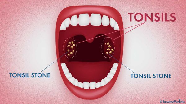 Tonsil stones