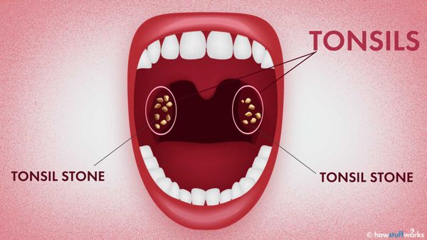 What in the World Are Tonsil Stones?