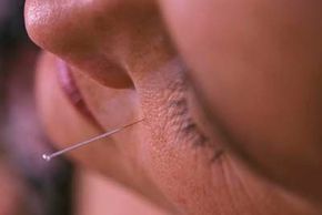 Acupuncture is a traditional Chinese medical practice often used to treat common ailments.