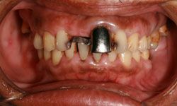 teeth and mouth that are infected