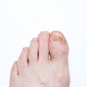 Viruses, fungi and bacteria cause nail infections. See more pictures of skin problems.