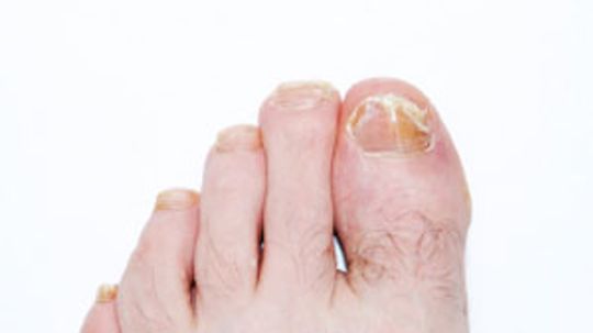 How to Treat a Nail Infection