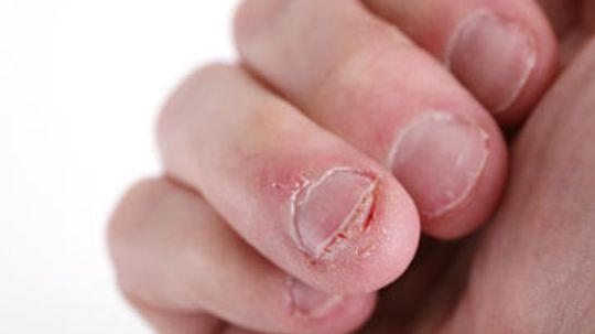 How to Treat a Torn Nail