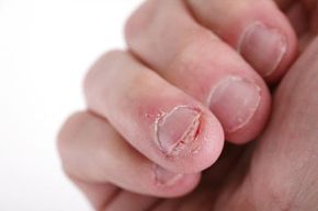 In extreme cases, a torn nail can separate from the nail bed. See more pictures of skin problems.